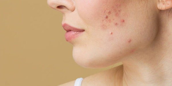 Cómo Combatir el Acné Hormonal de Manera Efectiva