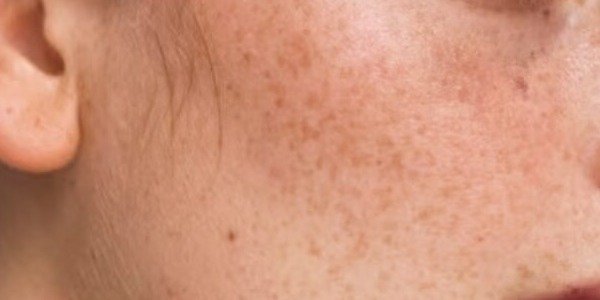 Guía Completa para Usar Cosméticos con Retinoides: Consejos y Precauciones desde tu Farmacia