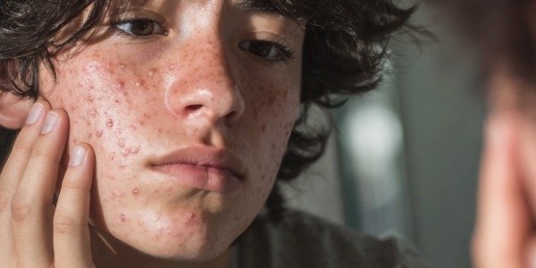 Adiós al acné post-verano: tu guía para retomar la rutina facial en septiembre